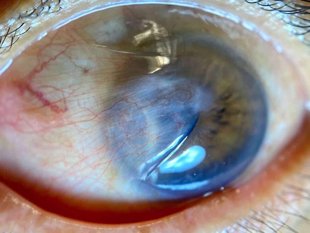 Pterygium Eye Surgery In Woodbridge VA | Singh Vision