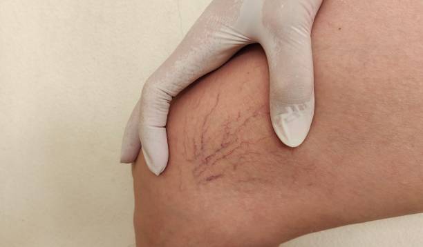 #1 Best Spider Veins Removal Treatment London