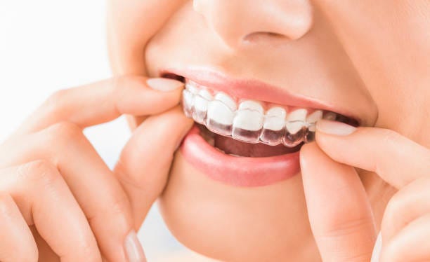 Caring for Your Invisalign Aligners: Tips for Best Results | by Pair Orthodontics | Jul, 2025 | Medium