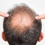 Hair Transplant In India Profile Picture