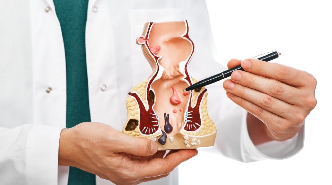 Laser Piles Surgery in Dehradun | Painless Treatment