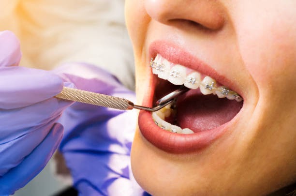 Why Braces Remain a Trusted Solution for Smile Alignment in Costa Mesa
