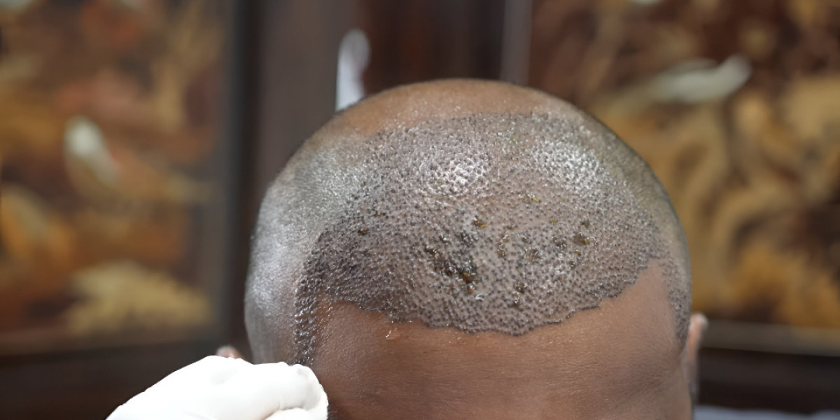 How to Prepare for a Hair Transplant in Islamabad