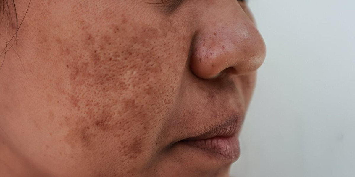 Could This Be Causing Your Skin Pigmentation?