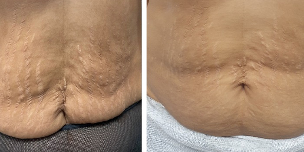 Stretch Mark Removal Treatment – Safe, Effective & Dermatologist-Approved