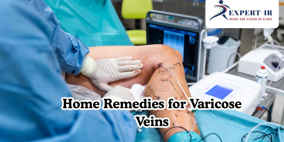 Home Remedies for Varicose Veins: Simple Solutions for Healthy Legs