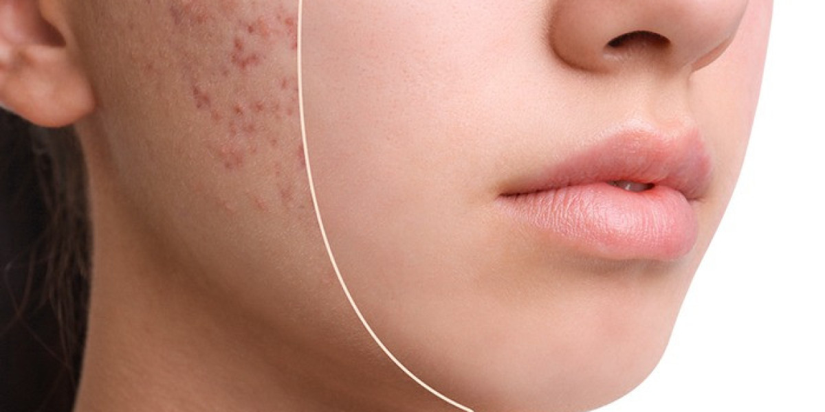 Acne Scar Treatment in Delhi – Restore Smooth & Clear Skin