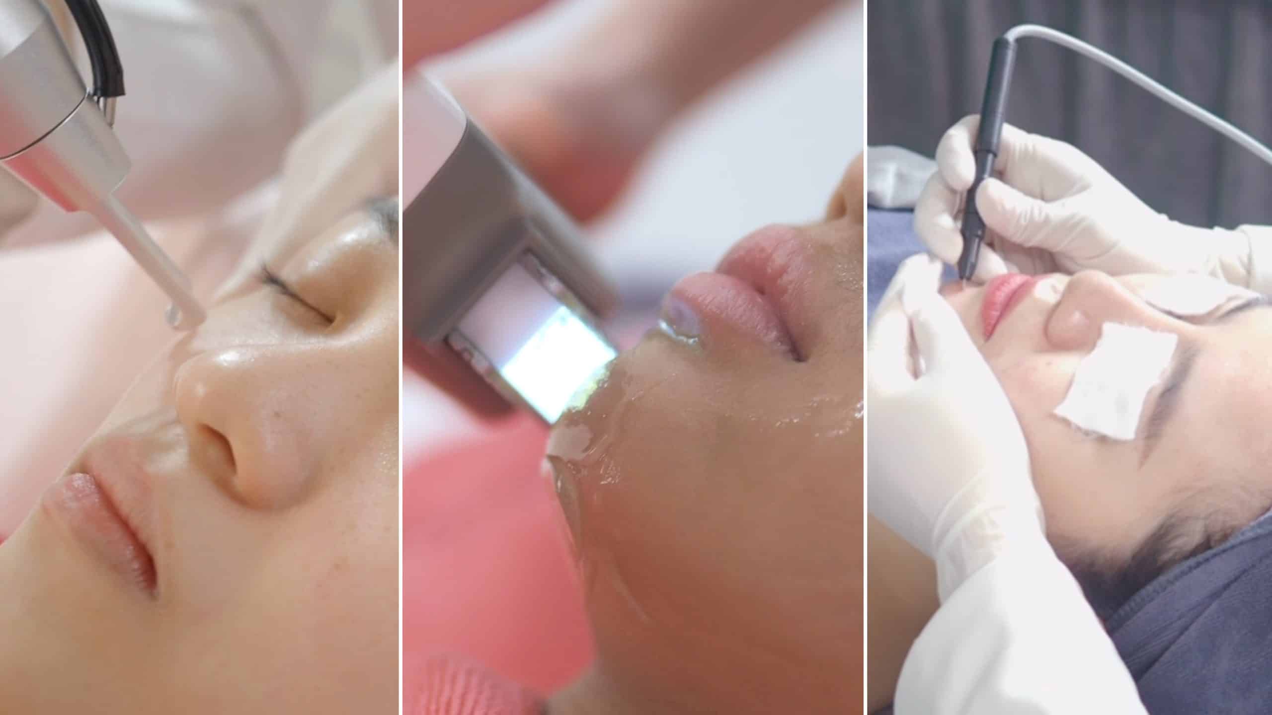 SSGM-9 Acne Program - MedicDeno Skin Solutions