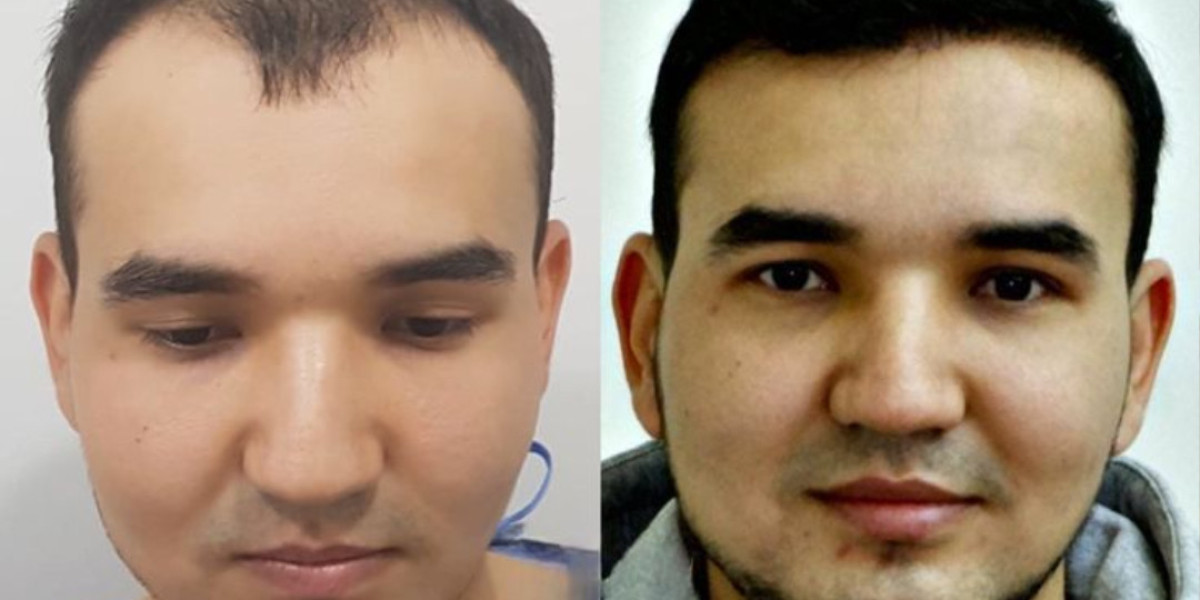 Finding the Best Surgeons for FUE Hair Transplant in Islamabad