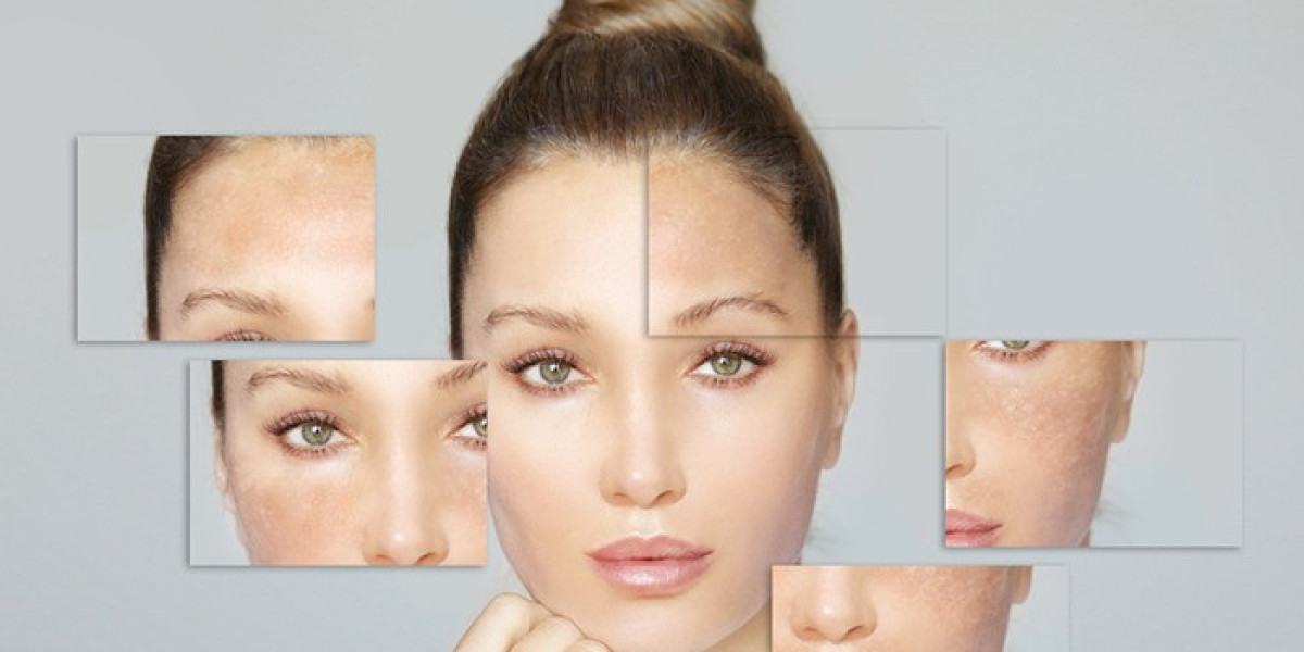 Pigmentation Treatment in Delhi: Effective Solutions for Clear and Even Skin