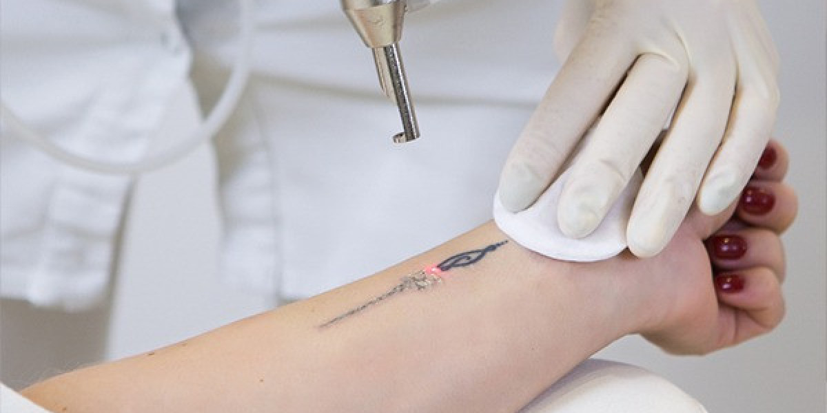 Laser Tattoo Removal in Delhi – Safe & Effective Solution