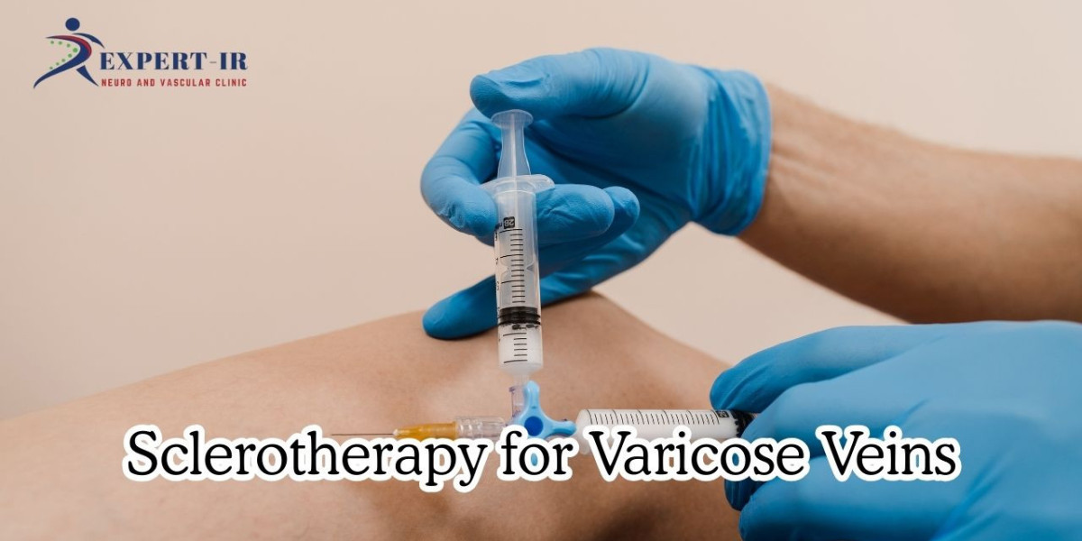 Sclerotherapy for Varicose Veins: Confidence in Your Legs