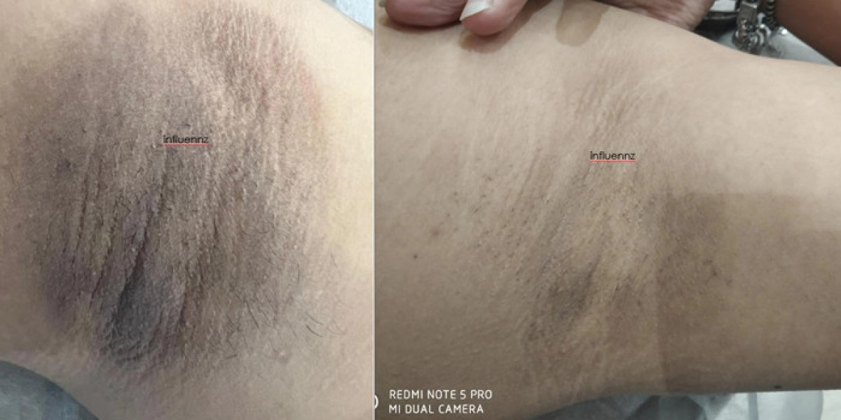 Dark Underarms Treatment – Restore Your Skin’s Confidence