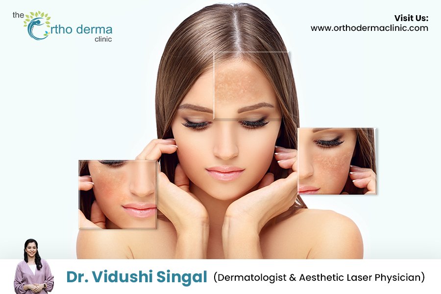 Melasma Treatment in Ludhiana | Causes & Solutions by Dermatologist