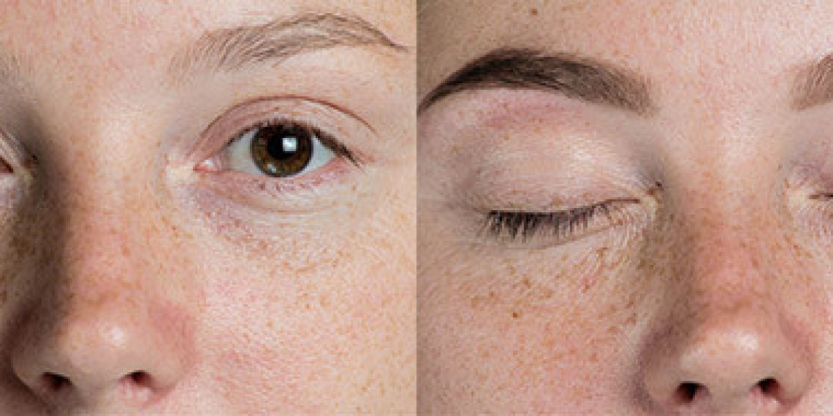 Complete Guide to Eyebrow Transplant in Los Angeles: Cost, Procedure, and Long Term Results