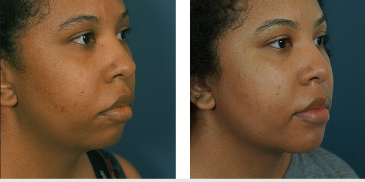 Enhancing Facial Definition and Confidence with Modern Facial Contouring Procedures