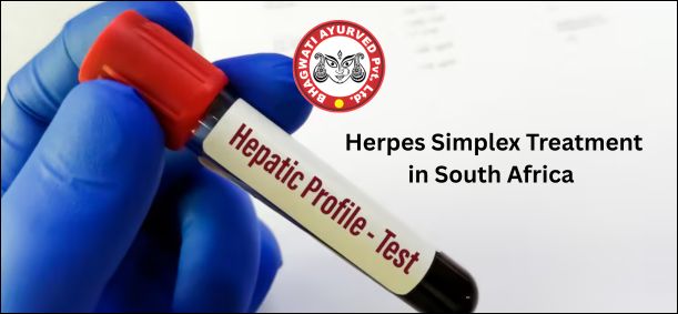 Herpes Simplex Treatment in South Africa - Bhagwati Ayurved