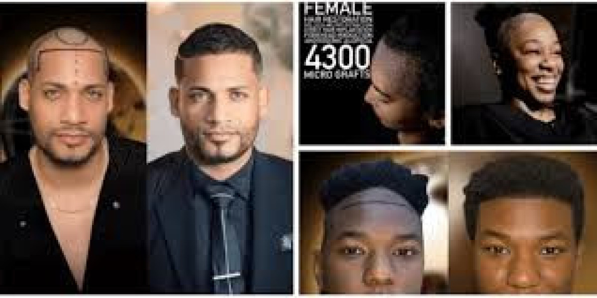 Hair Transplant Turkey Before and After: Real Results and Success Stories