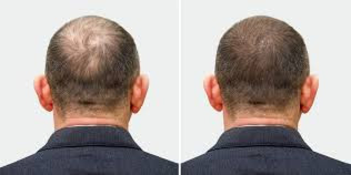 The Real Cost of a Hair Transplant in 2026: What You Need to Know