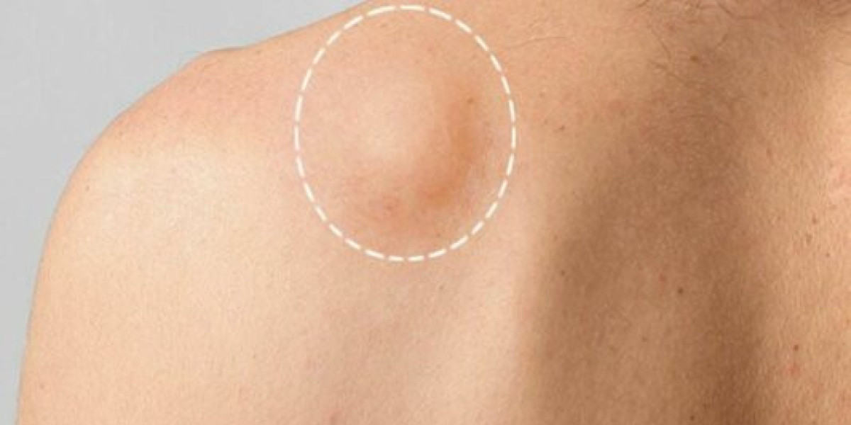 Best Lipoma Removal in Islamabad – Regain Comfort