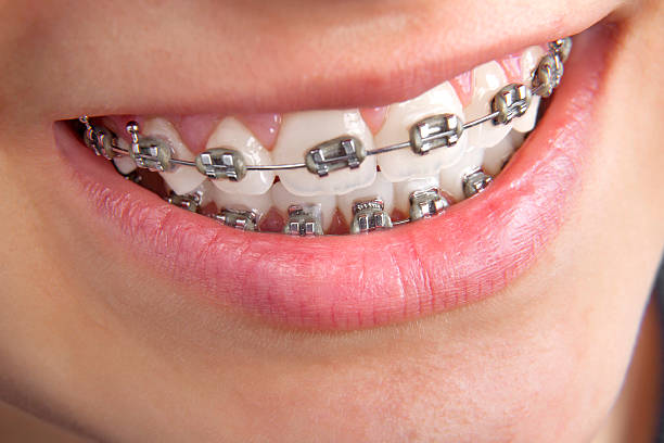 Modern Orthodontic Solutions: Finding the Right Braces for a Healthier Smile – GuestCountry