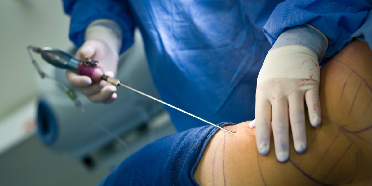 Liposuction Results Timeline: When Will You See Changes?