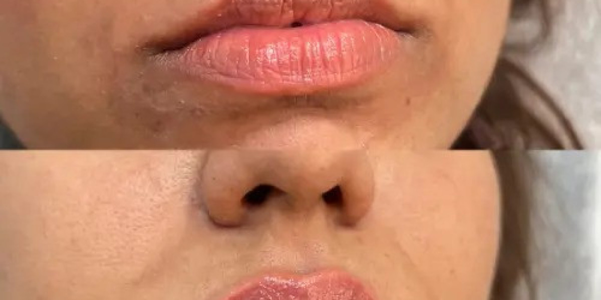 Lip Fillers in Delhi – A Complete Guide to Safe and Natural Lip Enhancement
