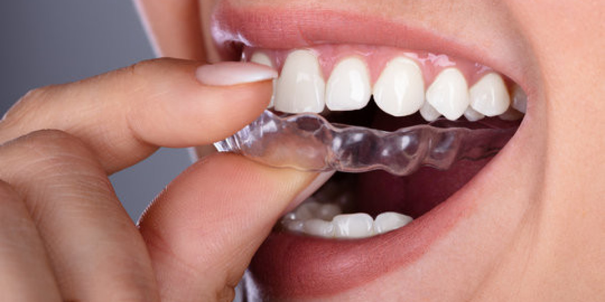 Teeth Aligners – Designed for Your Lifestyle