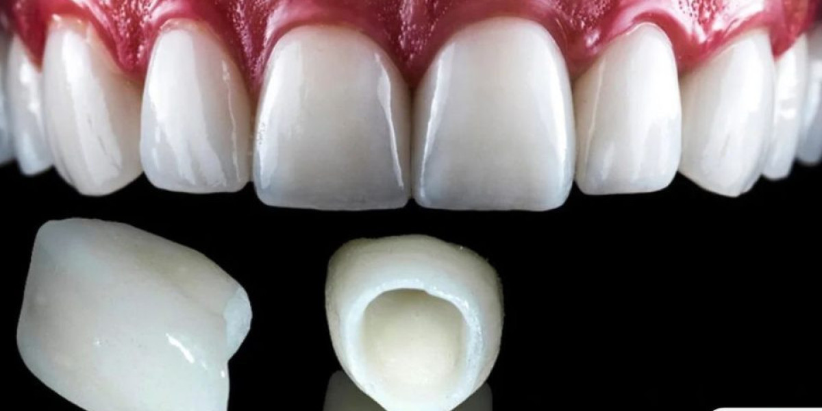 E-Max Veneers Smile Upgrade Designed for Radiant Confidence