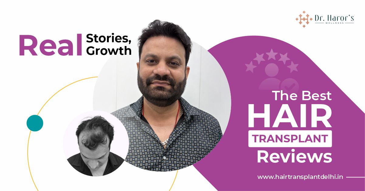 Hair Transplant Before and After Results: What Real Patients Say – Best Hair Transplant Clinic in Delhi, India