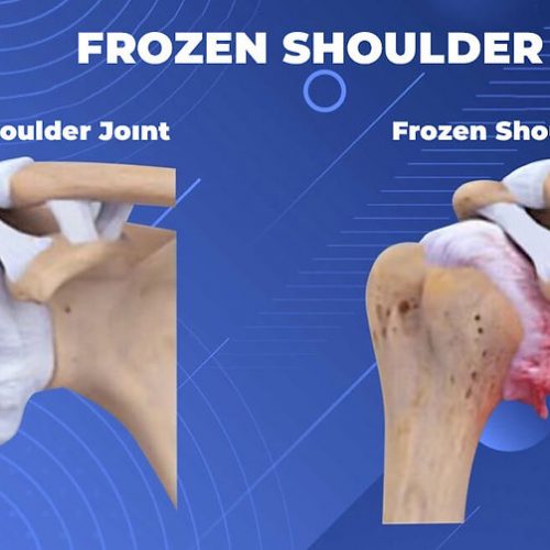 Frozen Shoulder - Miami Shoulder Institute