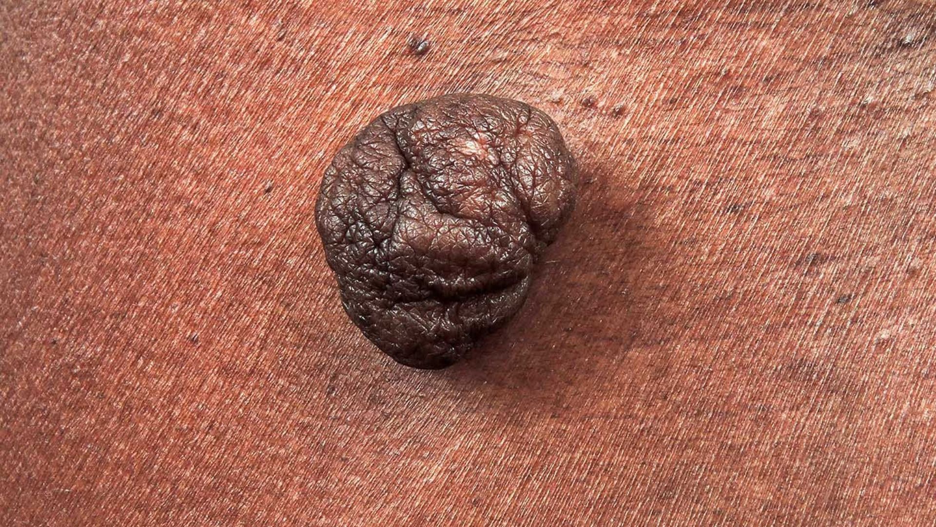 Skin Tag Removal | Interface Clinic