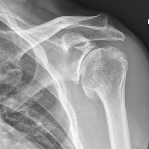 Rotator Cuff Tear - Miami Shoulder Institute