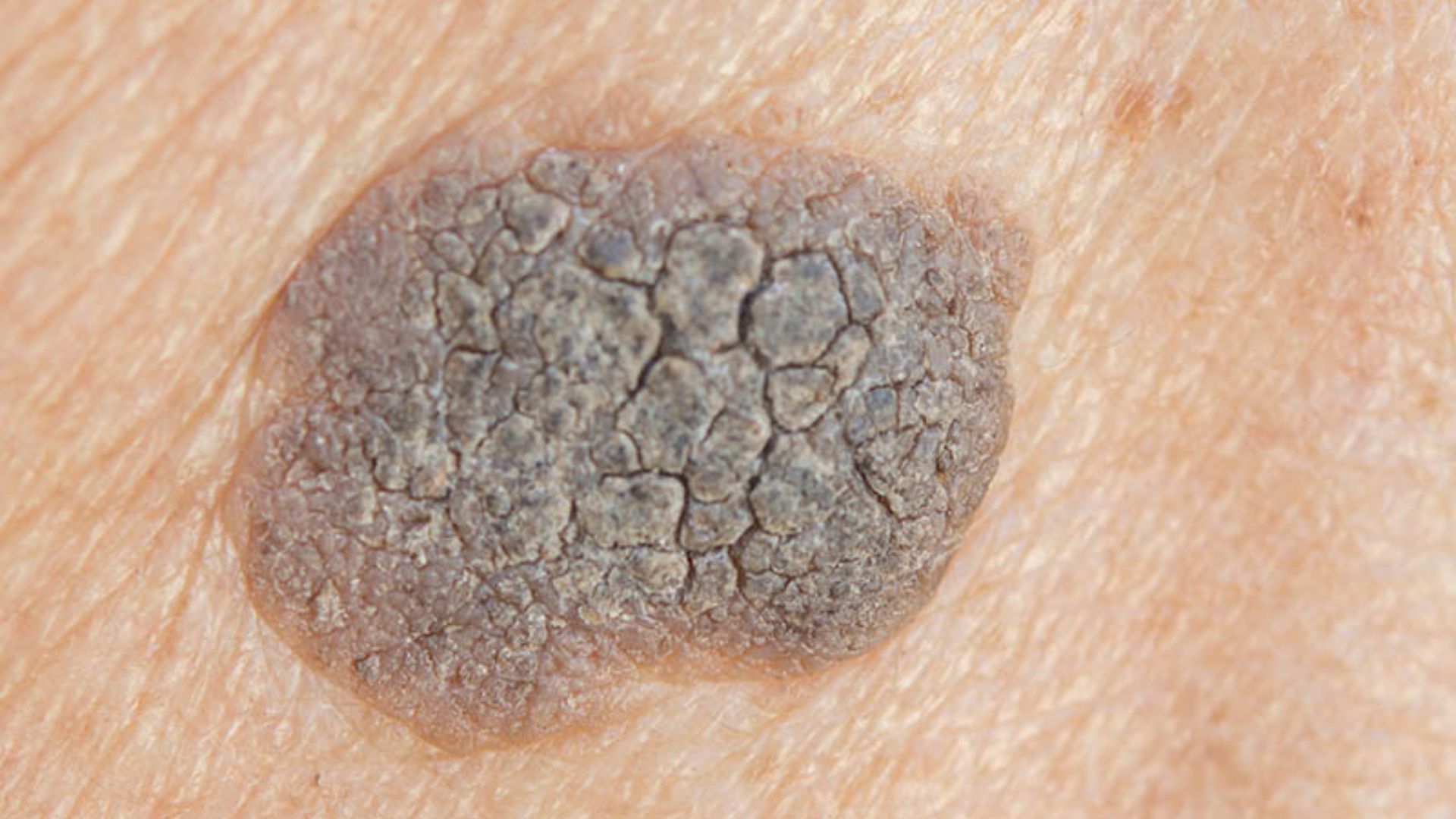 Seborrhoeic Keratoses Removal | Interface Clinic