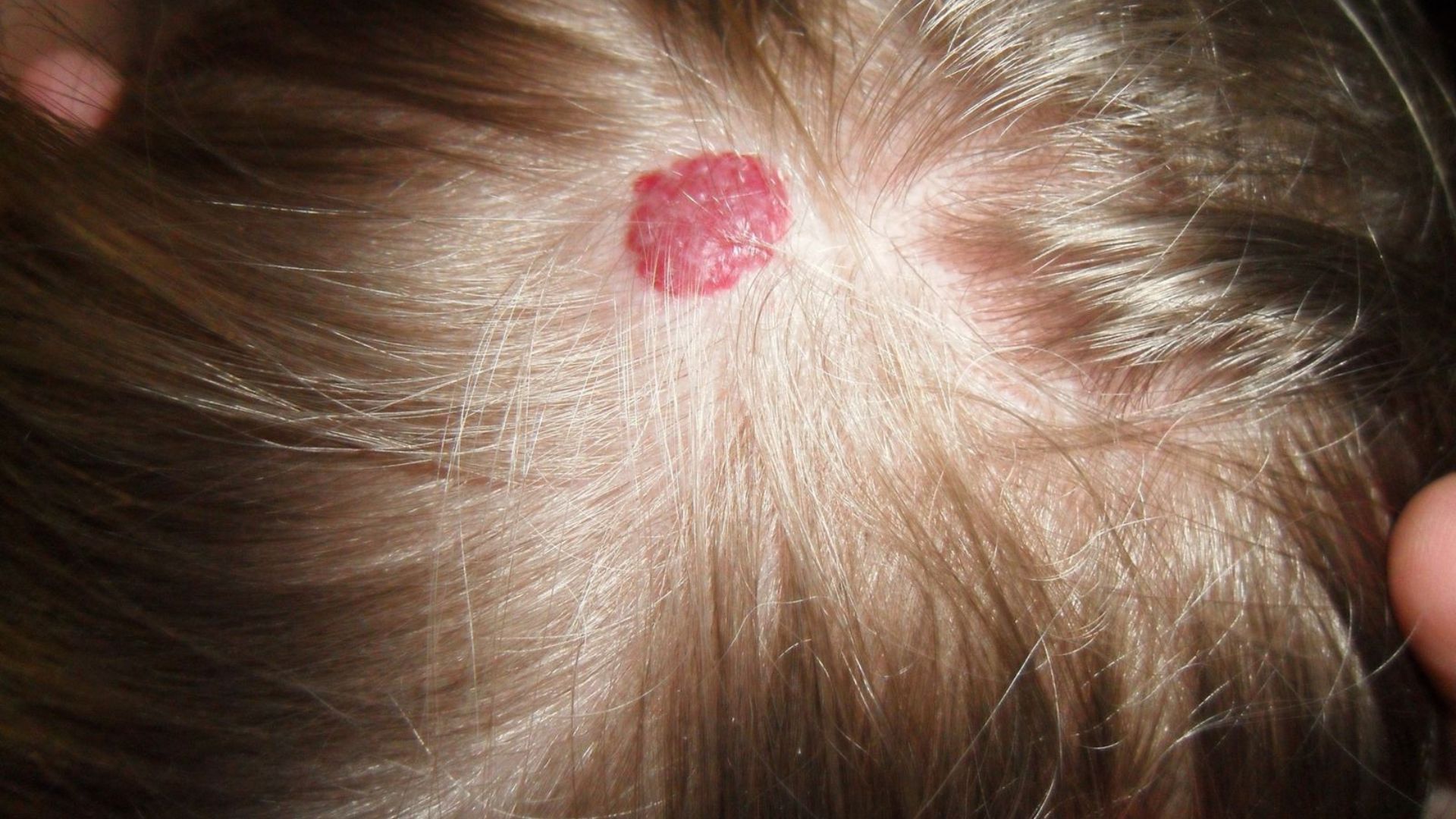 Haemangioma Removal | Interface Clinic