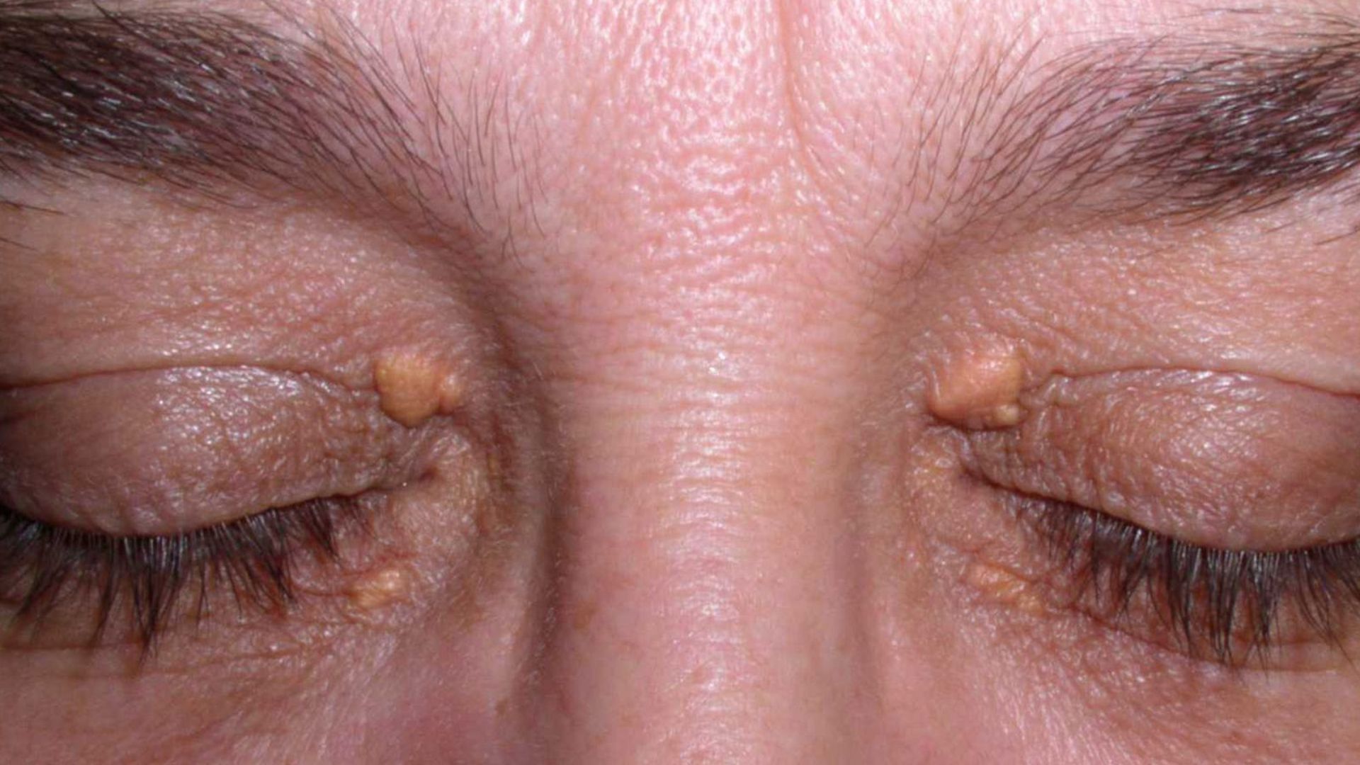 Xanthelasma Assessment & Treatment | Interface Clinic