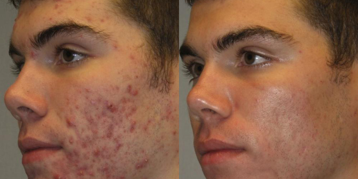 Who Needs Pimples Treatment in Dubai Most