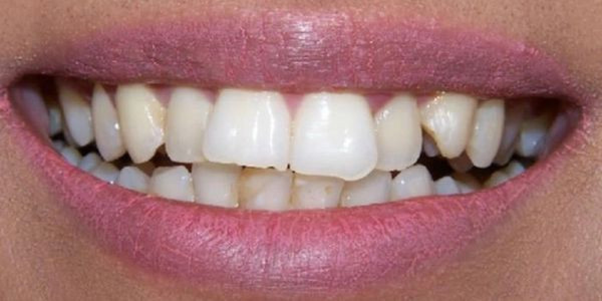 Non-Prep Veneers Unlock Radiant Beauty Through Modern Smile Design