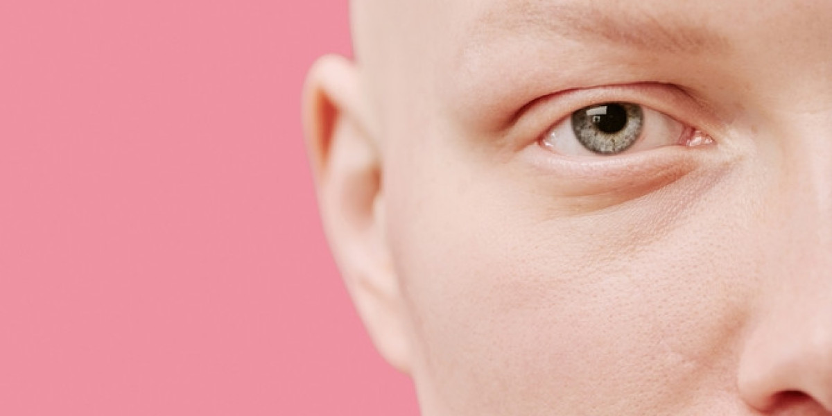 How Alopecia Universalis Is Diagnosed?